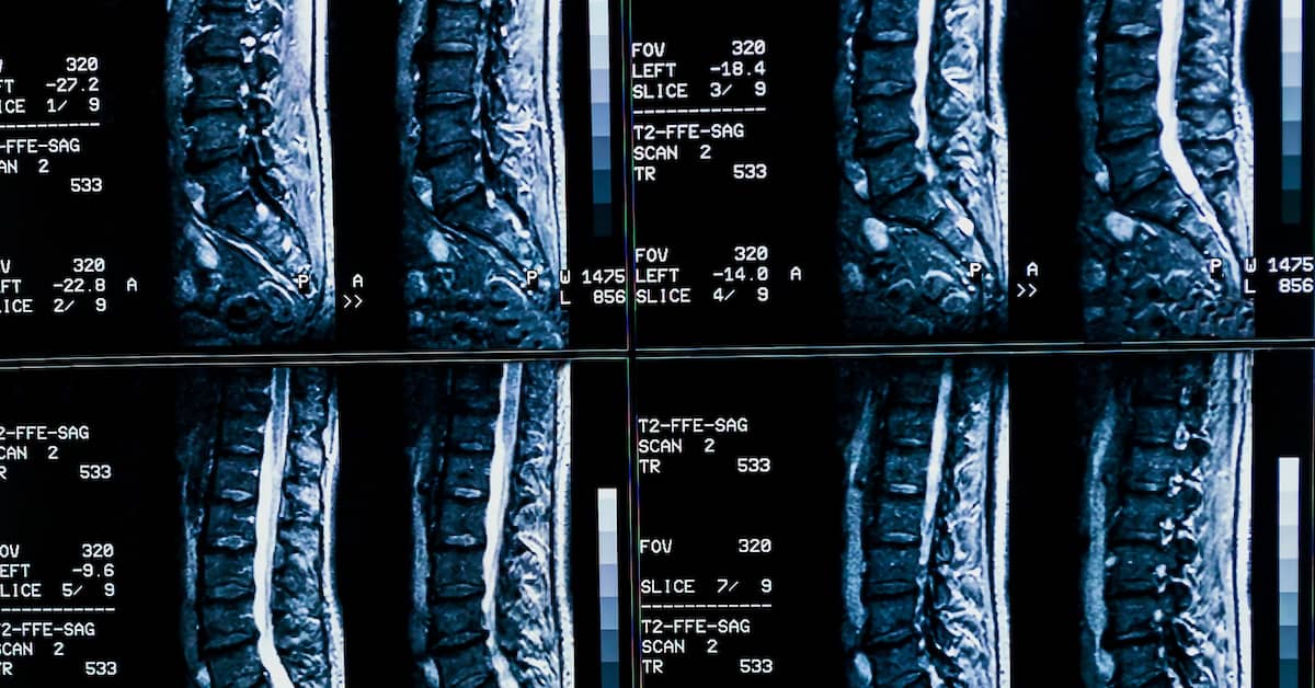 spine x-rays after a car accident | Mandell, Boisclair and Mandell, Ltd.